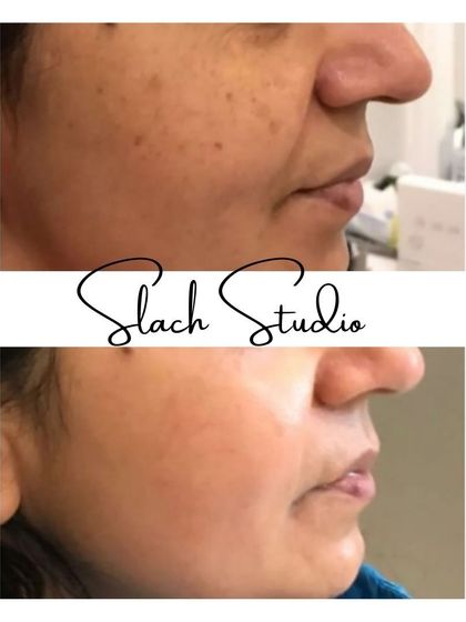 This side profile shows a dramatic improvement in skin clarity, with pigmentation and uneven texture resolved.