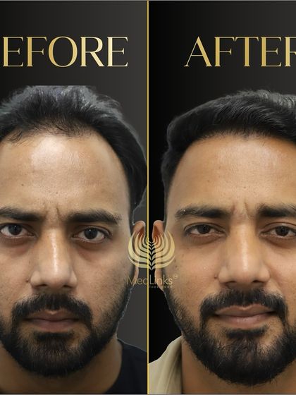 This before and after comparison shows a significant improvement in both hairline and overall density, resulting in a more youthful and confident look.