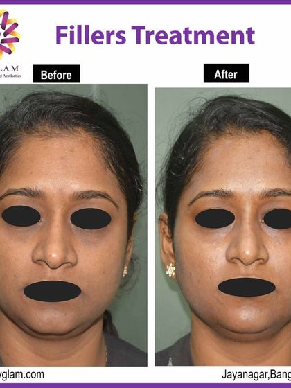 Another example of a successful filler treatment. By carefully placing dermal fillers, I was able to smooth out lines and restore volume, creating a subtle lift and a significantly more refreshed look for the client.