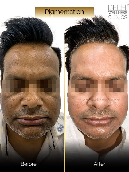 A frontal view of the same client, showing how the treatment evened out his skin tone across the forehead and cheeks, resulting in a brighter, more refreshed look.
