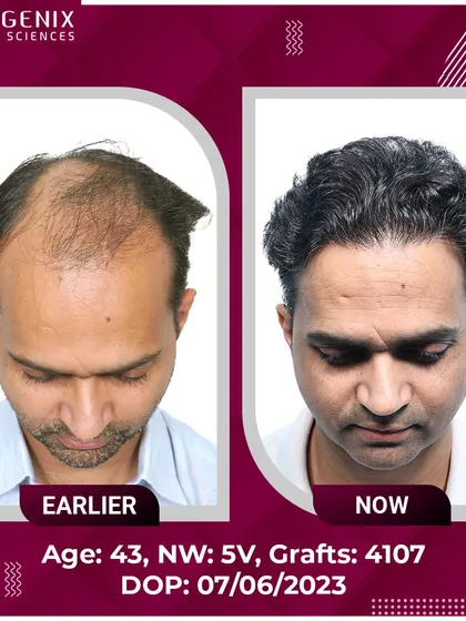 See the transformation of a 43-year-old with Grade 5V baldness, restored with 4107 grafts for a natural, lasting result.