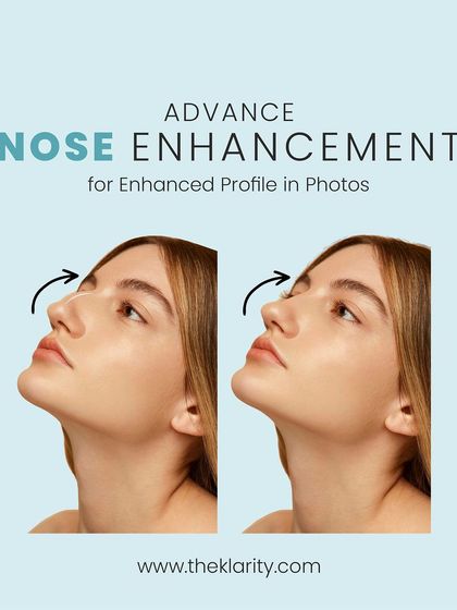 See the difference a non-surgical nose enhancement can make. Using advanced filler techniques, I can refine the shape and bridge of the nose to create a more harmonious and elegant profile.