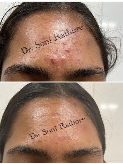 This before and after shows the clearing of persistent acne on the forehead. We are now in the next phase of treatment, working to reduce the remaining redness and smooth out the skin texture.