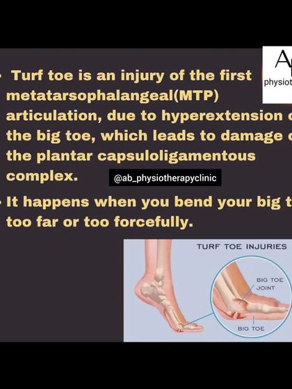 Turf Toe is a sprain of the big toe joint, often caused by hyperextension. It's a common sports injury that we treat to ensure athletes can return to play safely.