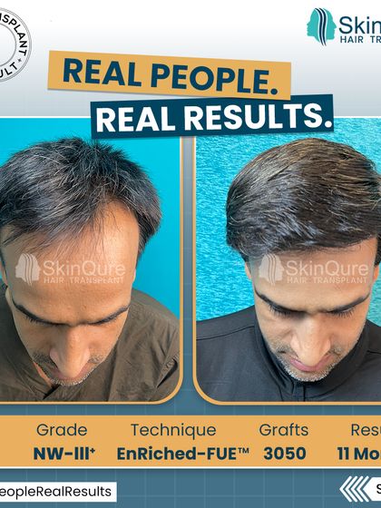 A top-down view of the 39-year-old patient with Norwood Grade III hair loss. The 11-month result after 3050 grafts shows impressive density and coverage, creating a full and healthy look.