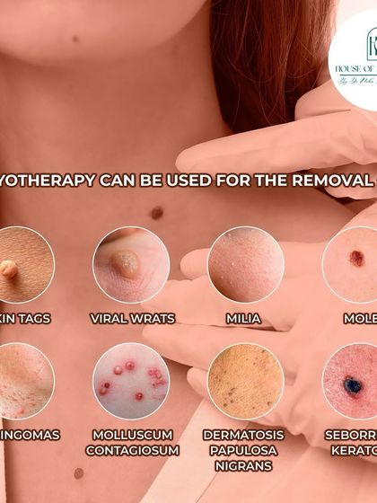 Cryotherapy is a versatile treatment that can be used for the removal of a wide range of skin growths. This includes skin tags, viral warts, milia, moles, syringomas, and other common dermatological concerns.
