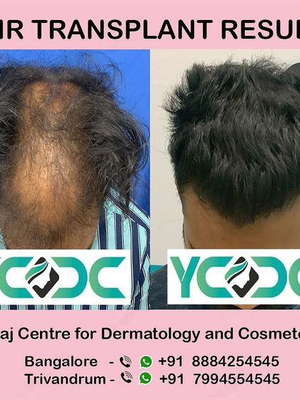 This result demonstrates my ability to handle cases of significant hair loss, restoring coverage across a large area of the scalp for a dramatic transformation.