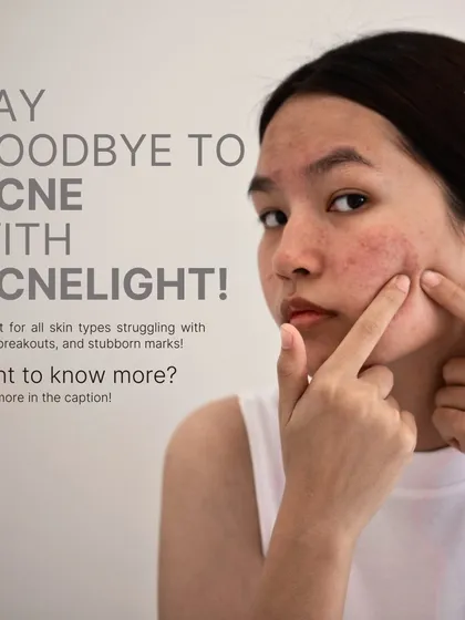 AcneLight is an FDA-approved light therapy that is perfect for treating active breakouts. It effectively targets acne-causing bacteria, reduces inflammation, and controls oil production, making it a safe and painless option even for sensitive, acne-prone skin.