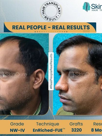A side profile view of a successful corrective hair transplant after 8 months. We used 3220 grafts with the EnRiched-FUE™ technique to rebuild the hairline and restore density for this 33-year-old patient, correcting a previous unsatisfactory result.