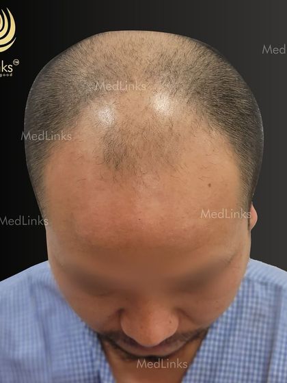 A top-down view of the patient's hair loss before the transplant.