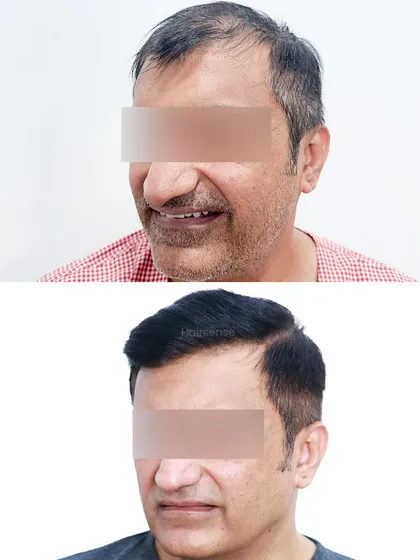 A split-image comparison showing the transformation from two different angles, highlighting both the hairline reconstruction and the overall increase in volume.