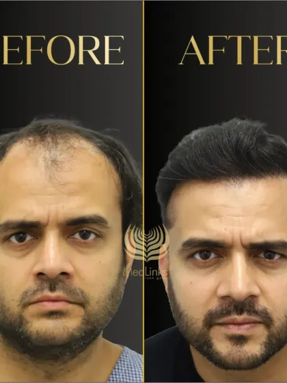This before and after comparison shows a remarkable change. The patient's confidence is visibly boosted by the full, natural-looking hairline we created for him.