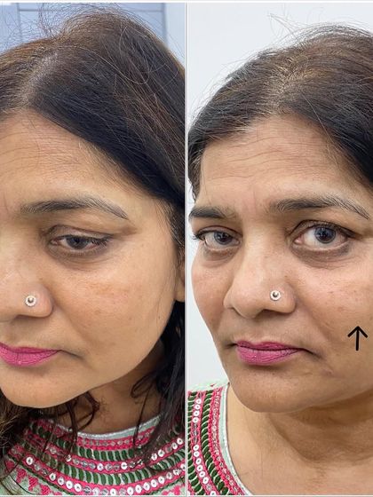 Another angle showcasing the results of a cheek and lower face treatment. The goal is to create a natural elevation, reversing age-related volume loss for a refreshed appearance.