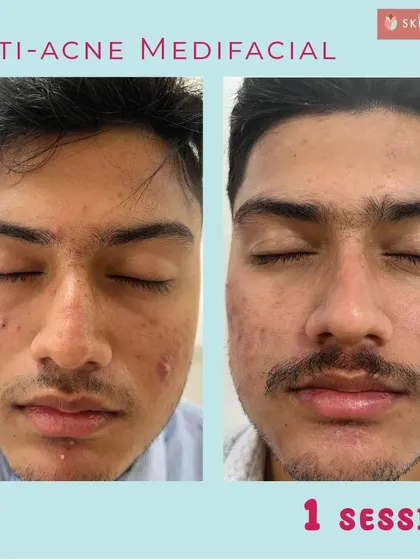 You can see visible improvement after just one session of our anti-acne medifacial. The initial treatment focuses on calming active inflammation and reducing breakouts. Subsequent sessions are designed to fade marks and improve overall skin texture for long-lasting clarity.