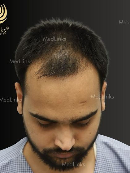 A top-down view of the patient's hair loss before the transplant.