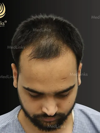 A receding hairline and thinning at the front can be a major concern. This before photo shows the extent of hair loss before we began our treatment.