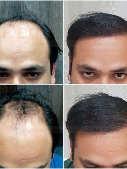 A four-panel before and after comparison showing the progression of hair growth and the final restored hairline. This highlights the significant improvement in coverage and the natural aesthetic we strive for.