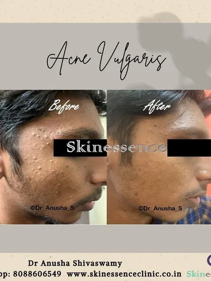 Here you can see a clear improvement in active acne and post-inflammatory marks after just 8-12 weeks of a consistent, medically supervised treatment plan. My approach focuses on controlling breakouts and preventing future scarring.