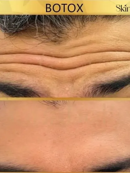 This before and after image shows the effectiveness of Botox in smoothing deep-set forehead lines. The treatment relaxes the underlying muscles, resulting in a significantly smoother and more youthful appearance.