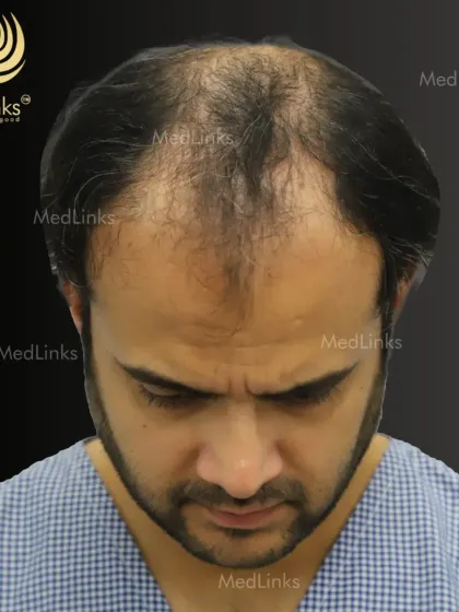 A top-down view clearly showing the area of baldness. This perspective is crucial for us to accurately measure the area and calculate the required number of grafts for a successful transplant.