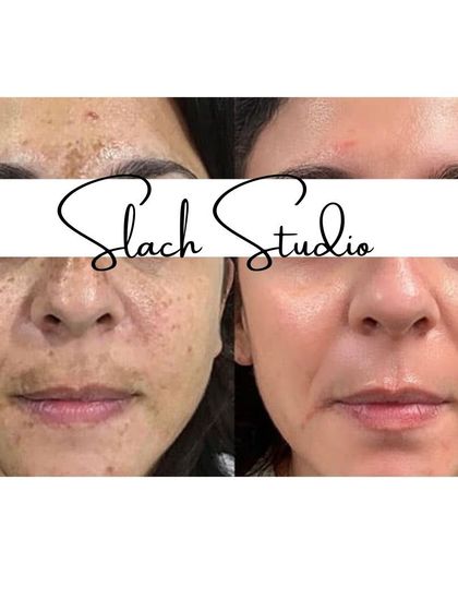 This client's skin is visibly brighter and more even-toned after the treatment, showing a healthy, natural glow.