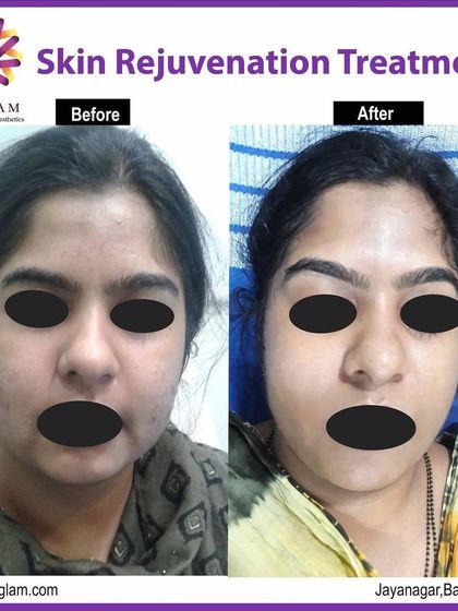 This client's skin rejuvenation treatment focused on clearing up acne and improving overall skin health. The 'after' image displays a significant reduction in active blemishes and a smoother, more even skin surface.