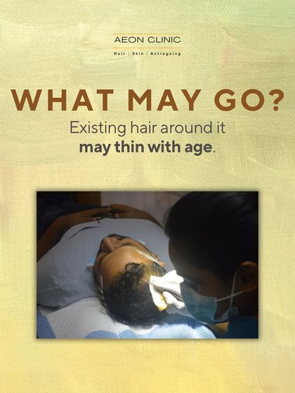 While transplanted hair is permanent, your existing, non-transplanted hair around it may continue to thin with age. This is why ongoing care is important.