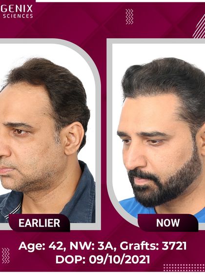 TV Actor Romanch Mehta shows his incredible transformation and explains how our results convinced him to overcome his fear of surgery.