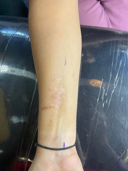 Scar Cover-ups: Turning Scars into Art photo 3