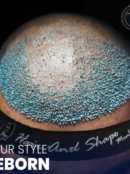 The "Your Style Reborn" tagline on this image is backed by the visual evidence of a meticulously crafted hairline. The band worn post-procedure helps manage swelling and is part of our standard aftercare protocol.