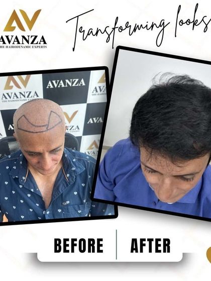 This image shows the pre-procedure markings for a new hairline and the fantastic, dense result. This is a life-changing procedure that restores both hair and self-esteem.