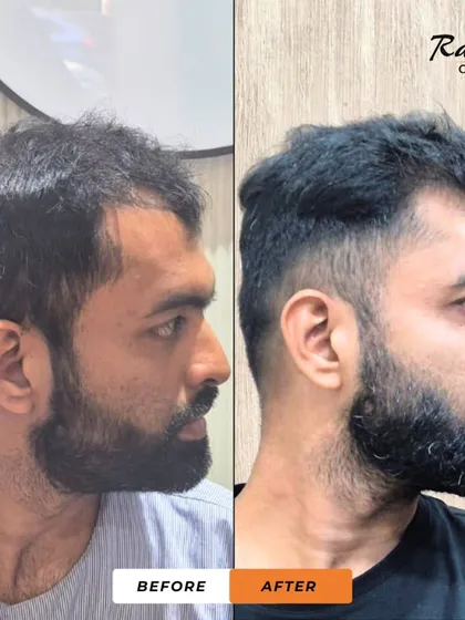 A side view of the patient from testimonial video 17. This image clearly shows the restored density and the sharp, clean hairline that gives him a much fuller look.