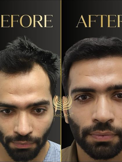 A fantastic before and after result. The patient's new hair looks natural, dense, and has completely revitalized his appearance.