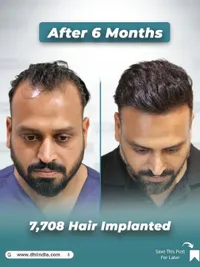 Hair Transplant Surgery