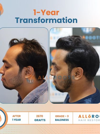 After one year, this patient's Grade 3 baldness was fully addressed with 2670 grafts. The transformation is evident in his smile and the natural, dense hairline that frames his face.
