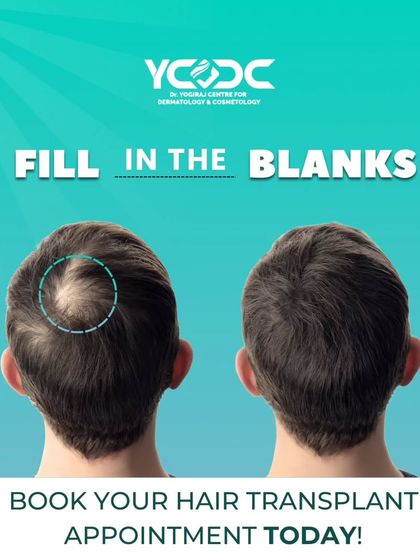 This graphic illustrates the concept of "filling in the blanks" with a hair transplant, showing how I address areas of thinning to create a complete and confident look.