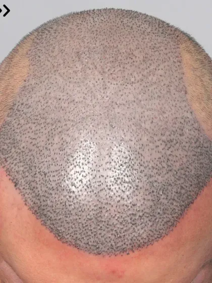 A high-grade baldness case just after surgery. 5700 grafts were used to recreate the hairline, frontal region, mid-scalp, crown, and temples.
