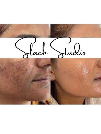 This result shows the treatment's ability to clear up acne scarring and pigmentation, leaving the skin looking fresh and renewed.