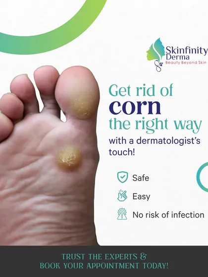 Painful corns on your feet can be a constant source of discomfort. We understand that over the counter solutions often fail to provide lasting relief. We focus on safe and effective clinical corn removal to not only treat the issue but also advise on how to prevent it from coming back.