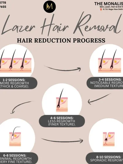 This infographic illustrates the typical hair reduction progress you can expect. While initial sessions show some regrowth, the hair becomes noticeably finer and sparser after 4 to 6 sessions, leading to long-term, smooth results.