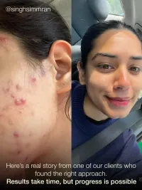 Acne & Scar Treatments