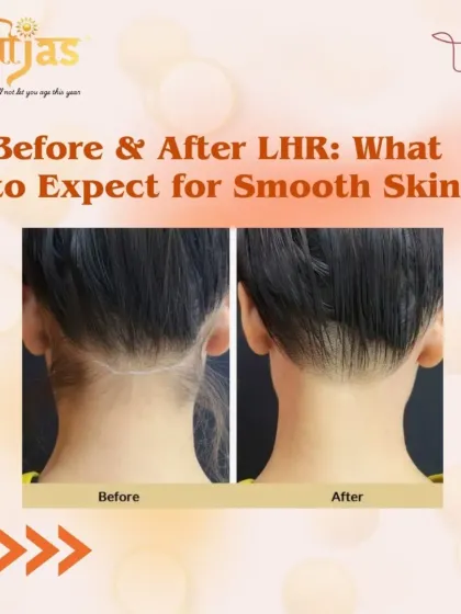 This is a perfect example of how laser hair reduction can clean up the neckline. The treatment effectively targets unwanted hair, resulting in a sharper, cleaner look with significantly reduced growth, eliminating the need for frequent shaving or trimming.
