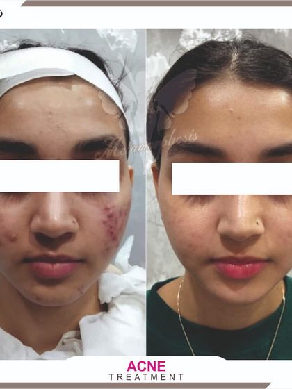 This image shows the front view of a client's progress, with a significant decrease in redness and active acne.