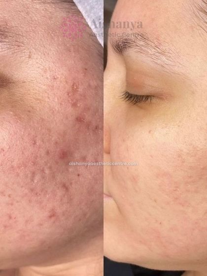 This before-and-after shows a remarkable improvement in both acne and post-inflammatory hyperpigmentation. A combination of treatments helped clear the breakouts and even out the skin tone, revealing healthier skin.