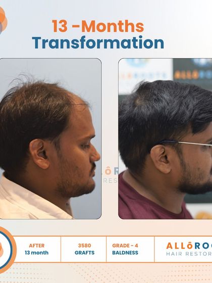 This 13-month transformation of a Grade 4 baldness case was achieved with 3500 grafts. Notice the natural density and the restored hairline from all angles, including a close-up view of the new hair growth.