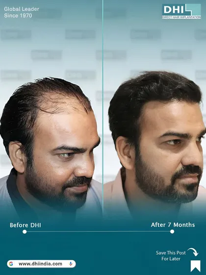 Another angle of the same client's 7-month transformation. This side view highlights the seamless integration of the transplanted hair with his existing hair, creating a completely natural look.