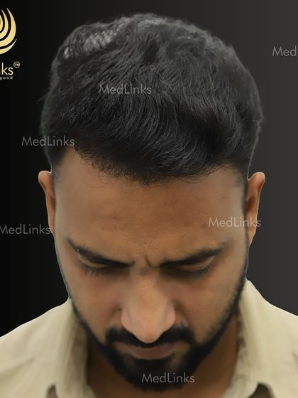 The top-down view after the transplant, showing excellent coverage and density.