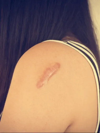Scars from old injuries or surgeries can be a source of self-consciousness. I offer customized scar revision treatments designed to reduce their visibility and improve skin texture, helping you feel more confident in your appearance.