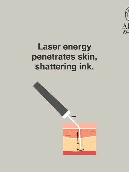 This diagram shows the first step of tattoo removal, where laser energy penetrates the skin to shatter the ink particles into smaller fragments.