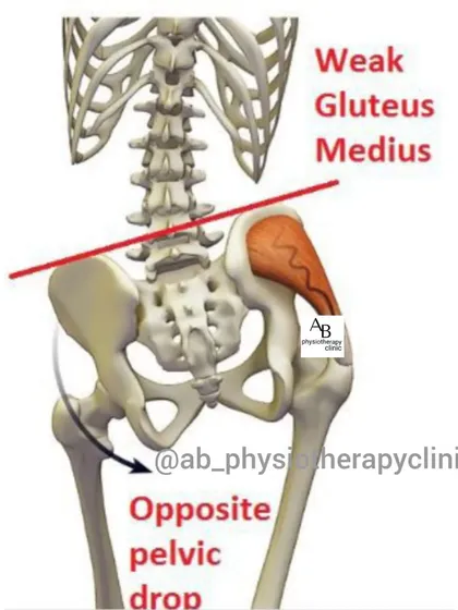 A weak gluteus medius muscle can cause the opposite side of the pelvis to drop, leading to an unstable gait and contributing to lower back pain. We focus on strengthening this crucial muscle.